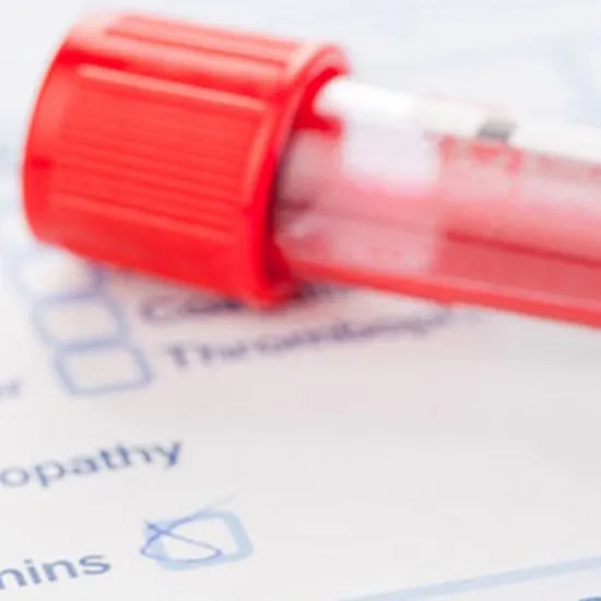 MUMPS VIRUS IgM ANTIBODY Test